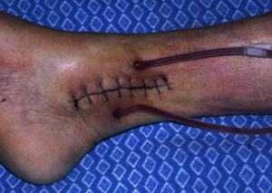 Blood-filled loop of tubing loop and row of stitches in an ankle