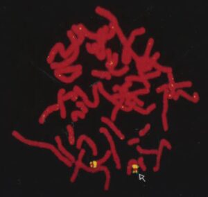 Image looks like a bundle of red worms that are chromosomes, with yellow spot on each copy of chromosome 22.