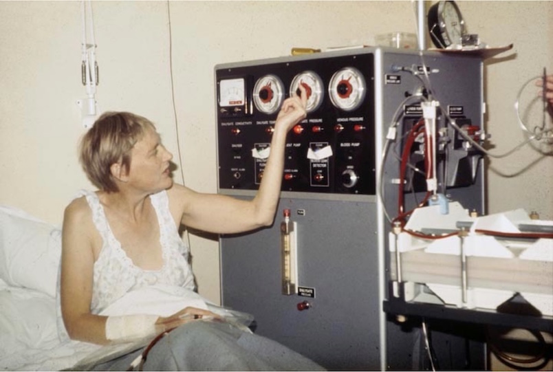 Woman operating her dialysis machine from bed. Arteriovenous shunt and blood lines visible at right wrist.